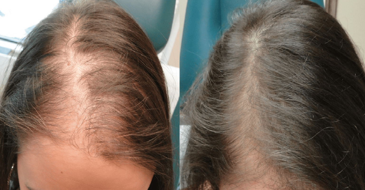 lecba padani vlasu pred po 2 e1664188815715